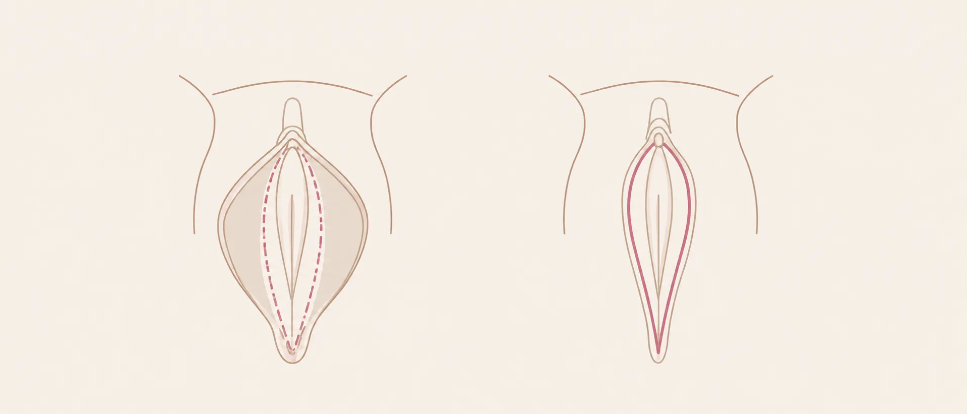 Cicatrice d'une nymphoplastie : à gauche le tracé de résection le long du bord des petites lèvres, à droite la cicatrice obtenue