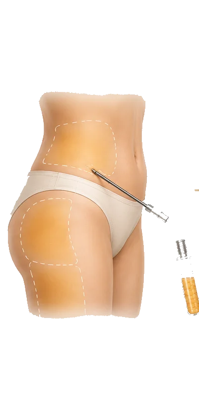 Étape 1, le prélèvement : liposuccion douce des zones donneuses
