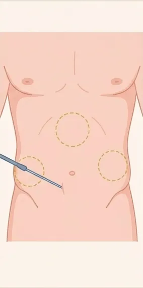 Élargissement du pénis : prélèvement de la graisse par liposuccion à l'abdomen et aux flancs