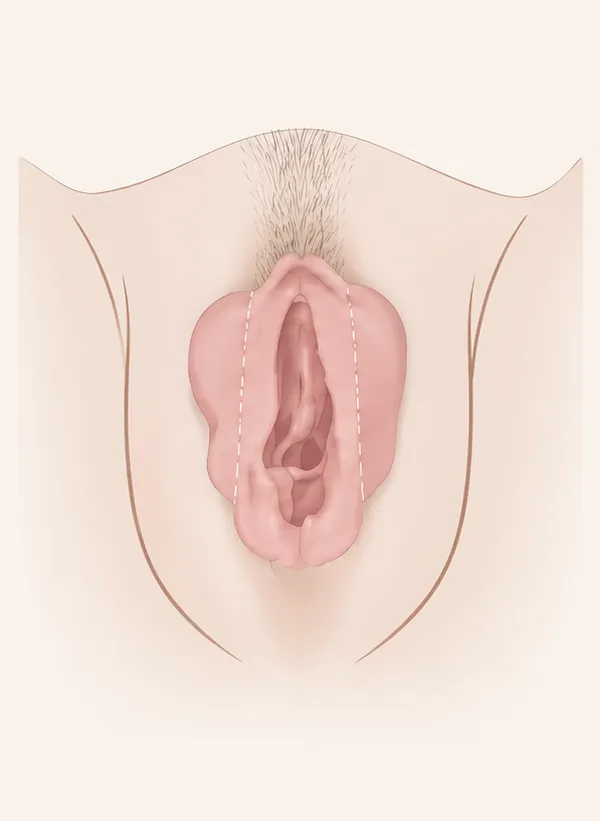 Nymphoplastie : le tracé de résection dessiné sur les petites lèvres avant le geste