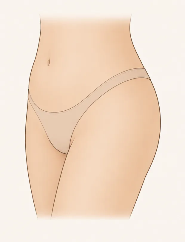 Après cicatrisation d'une liposuccion du mont de Vénus : le relief du pubis affiné, intégré à la silhouette