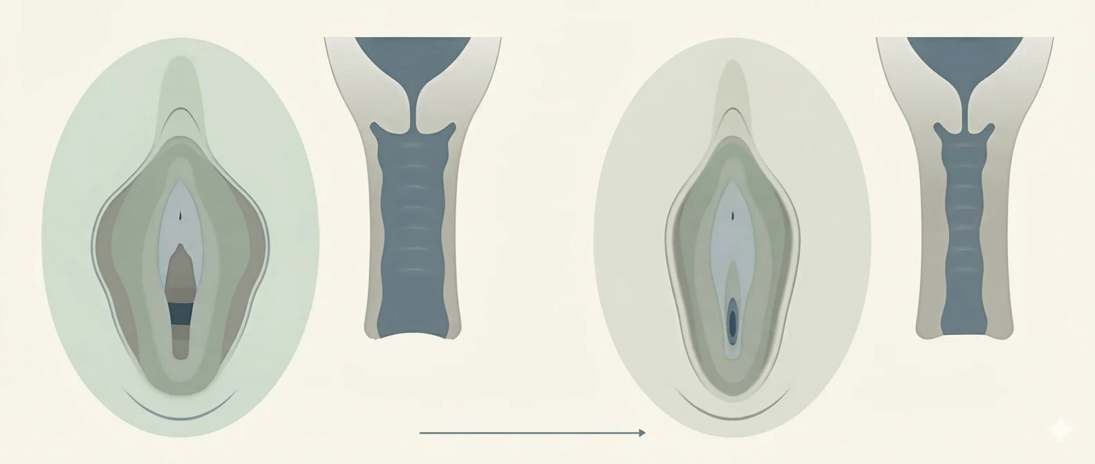 Schéma d'une vaginoplastie : le calibre du canal vaginal et le soutien du périnée, avant et après l'intervention